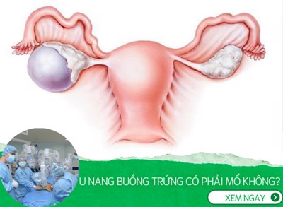 Bệnh u nang buồng trứng có phải mổ không?